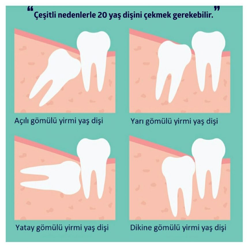 20 Yaş Dişleri Ceren Dental Clinic